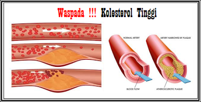 makanan sedap; penyebab kolesterol; kaki makan; makanan yang mempunyai kolesterol; kolesterol jahat; sakit jantung; stroke 