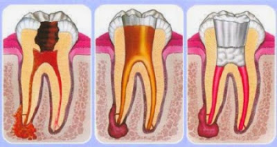 Dấu hiệu nhận biết viêm tủy răng