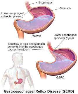 WHAT IS ACID REFLUX