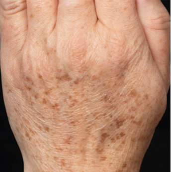 Đốm đen xuất hiện trên da tay là bệnh gì?