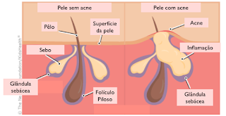  acne imagens, acne grau 1 2 3 4 5, tipos de acne no rosto, acne tipos fotos, graus de acne, acne grau 2, acne como tratar, o que é acne, acne tratamento caseiro