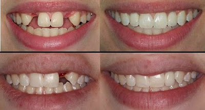 Trồng răng Implant khi mất nhiều răng