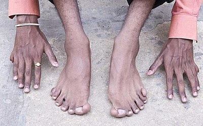 Extraordinary Indian Man With 12 Fingers 14 Toes