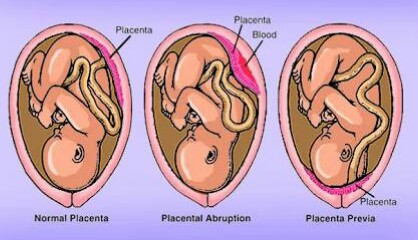 abruptio-plasenta