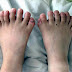 A CHINESE BOY (6) (LI JINPENG) BORN WITH 16 TOES