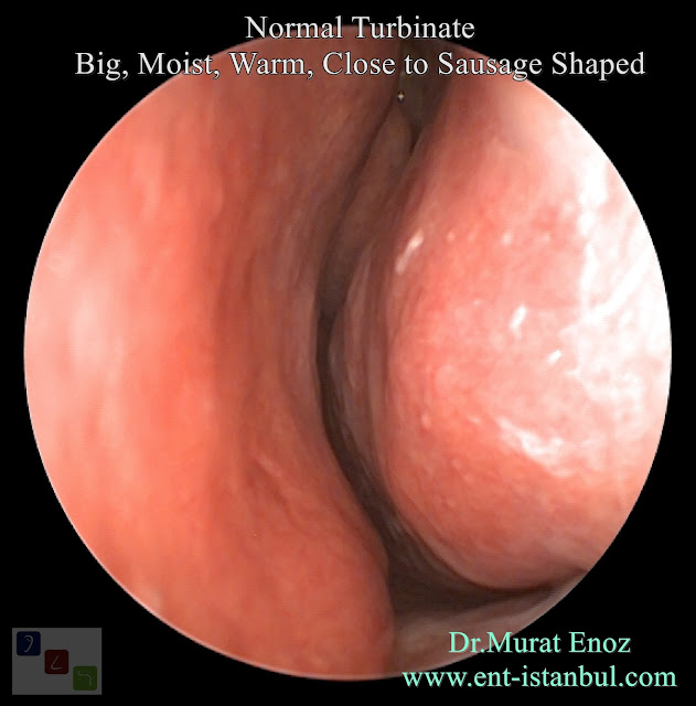 Normal Turbinate - Big, Moist, Warm, Close to Sausage Shaped