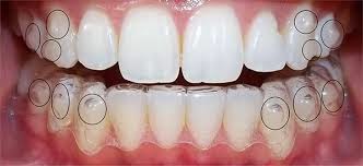 Có hai loại niềng răng: loại cố định và loại có thể tháo lắp dễ dàng được