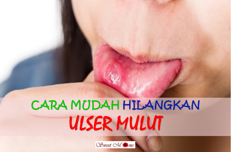 Cara Mudah Hilangkan Ulser Yang Pedih Dan Menyakitkan 