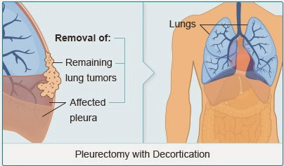 Pleural Mesothelioma