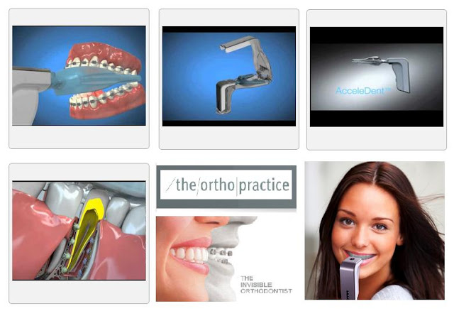 AcceleDent Device System - The Ortho Practice