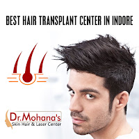 hair transplant in Indore