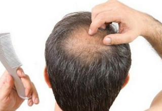 How Hair Restoration Procedures Combat Baldness 