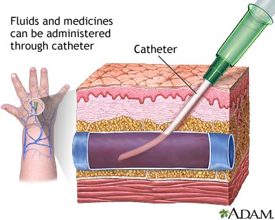 ALKES A: Catheter