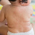 Baby's pustular rash! Rash after high fever? What are the symptoms?