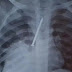 Menino de 3 anos morre após ficar um ano com prego no pulmão | Brazil News Informa