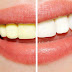 Quy trình bọc răng sứ cho răng nhiễm tetracycline