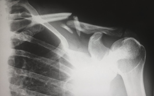 X-Ray Image of a Shoulder