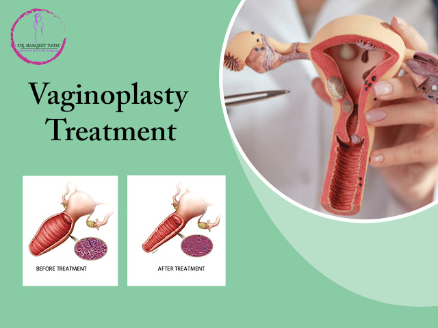 vaginoplasty in Bangalore