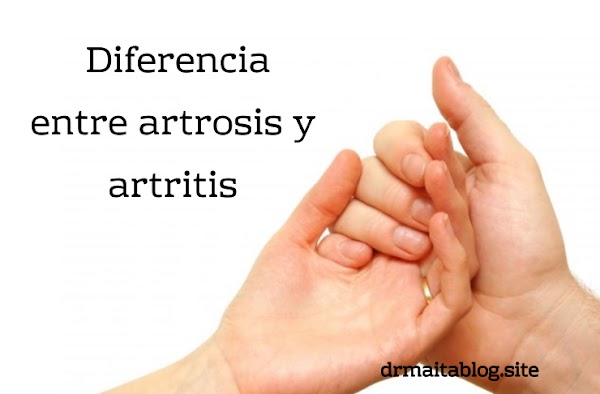  Diferencia entre artrosis y artritis