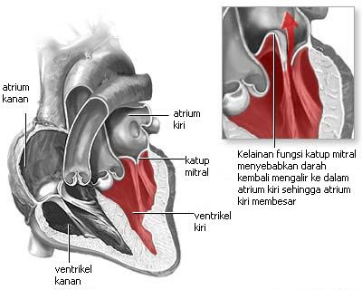 Prolaps katup mitral