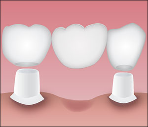 Bridge Dental6