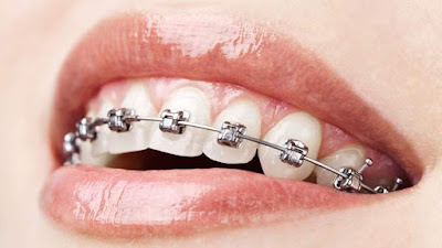 Teeth Straightening Treatments