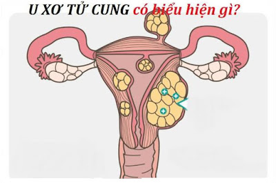 Những biểu hiện nhận biết sớm bệnh u xơ tử cung