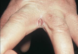 Les dermatophytoses (ou dermatophytie ou dermatomycose) sont des infections de la peau ou des phanères dues à des champignons microscopiques filamenteux : les dermatophytes. Ils appartiennent à 3 genres, Trichophyton, Microsporum et Epidermophyton. Ces champignons sont kératinophiles, ils ont une prédilection pour la kératine de la couche cornée de la peau, des poils, des cheveux et des ongles chez l'être humain, de la peau, des poils et des griffes chez l'animal.