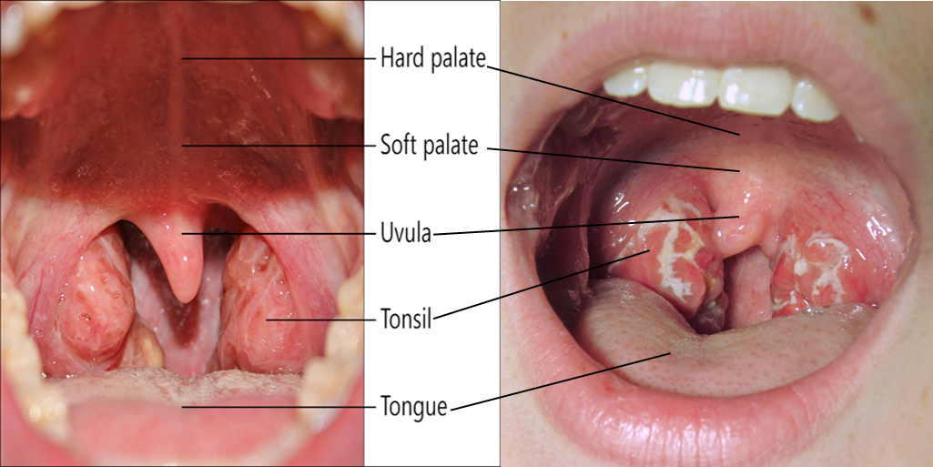 Tonsil Anak Bengkak?  MAMAPEDULI by DARLING HANIE