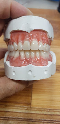 Qué es una prótesis dental