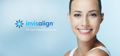 Niềng răng Invisalign là gì?