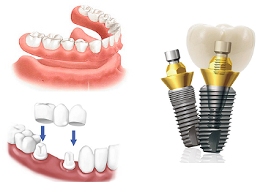 Cấy ghép Implant nha khoa