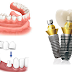 Cách giảm đau sau khi cấy ghép Implant?