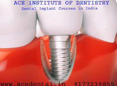 Dental Implant Courses in India, Dental Implantology Courses in India