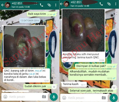 Cara Ampuh Mengobati Borok Bernanah Secara Alami, Cepat & Sampai Kering