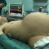 Man Undergoes Surgery to  Remove Huge Tumour Making  Him Look Like a Pregnant (Viewers  Discretion)