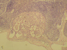 Metástasis de adenocarcinoma en linfonódulo