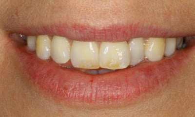 Răng mới vàng thích hợp tẩy trắng răng bằng máng