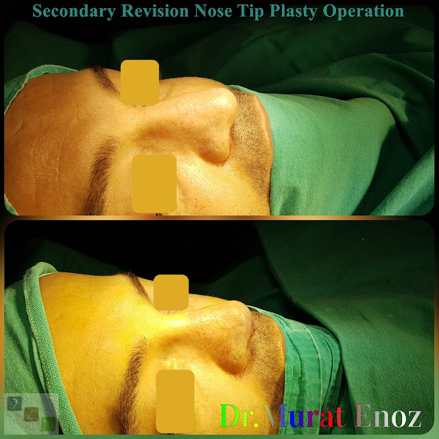 Revision Nose Tip Plasty in Men Istanbul