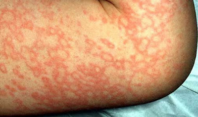 Fifth Disease Rash Pictures5
