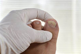 Fungal Infection - Understanding Toenail Fungus and How to Treat It