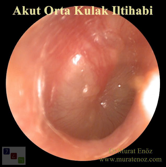 Acute Otitis Media