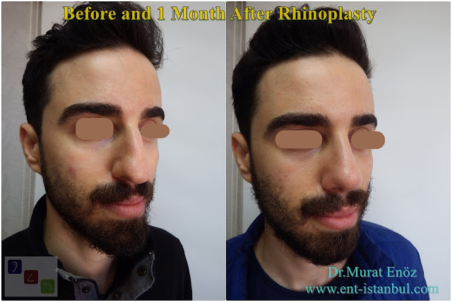 Rhinoplasty For Men Istanbul,crooked nose job,Asymmetric nose operation,Micro-Motor Assisted Rhinoplasty Operation Istanbul,Twisted Nose Aesthetic,