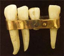 <img src="primera-prótesis-fija.jpg" width="170" height="170" border="0" alt="Imagen de la primera prótesis fija, diseñada para restaurar la capacidad de masticar y mejorar la nutrición.">