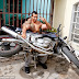 INCREIBLE: Un joven brasileño se inyecta aceite y alcohol en los bíceps para aumentar su musculatura
