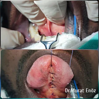 Ankyloglossia,Diagnosis of Tongue Tie,Treatment of Tongue Tie,Tongue tie surgery,Frenulectomy,Post-Operative Instructions for Tongue Tie Surgery,Symptoms of Tongue Tie,tongue tie,Frenectomy,