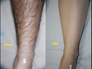 How to remove unwanted hair permanently