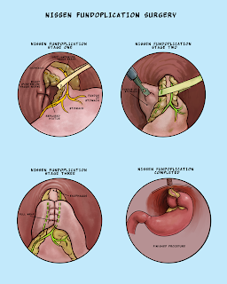   hernia คือ, โรคไส้เลื่อนในผู้หญิง, ไส้เลื่อน อาการ วิธี-รักษา, ไส้เลื่อนลงอัณฑะ อาการ, สมุนไพรรักษาโรคไส้เลื่อน, วิธี รักษา โรค ไส้เลื่อน, ไส้เลื่อน ภาษาอังกฤษ, โรคไส้เลื่อน ภาษาอังกฤษ, ไส้เลื่อนสะดือ ผู้ใหญ่