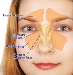 sinusitis