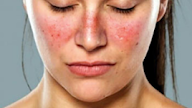 Weight Loss Rash Symptoms